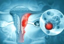Photo of India’s First Indigenous HPV Test Validated To Make Cervical Cancer Detection Affordable